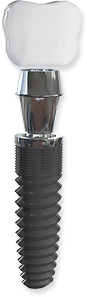 Dental implant