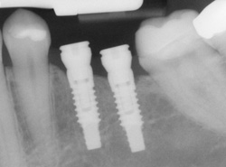 Dental implants on a x-ray