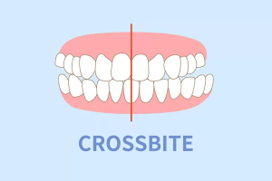 crossbite