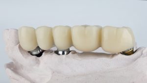 model of implant bridge