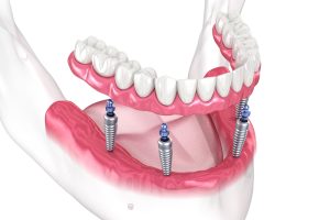 3d render of all on x implants