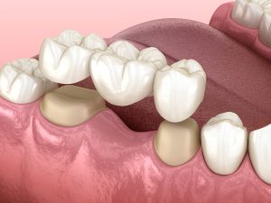 model of a dental bridge
