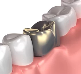 gold tooth 3d model