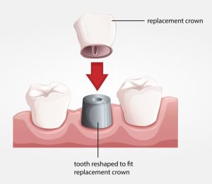 PFM Crowns 3D Model