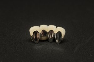 porcelain fused ot metal crown