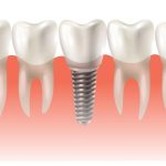 the first 72 hours a patients guide to dental implant recovery
