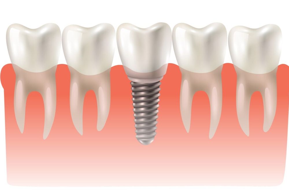 the first 72 hours a patients guide to dental implant recovery
