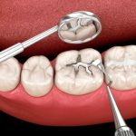Can Dental Fillings Prevent Future Tooth Damage?