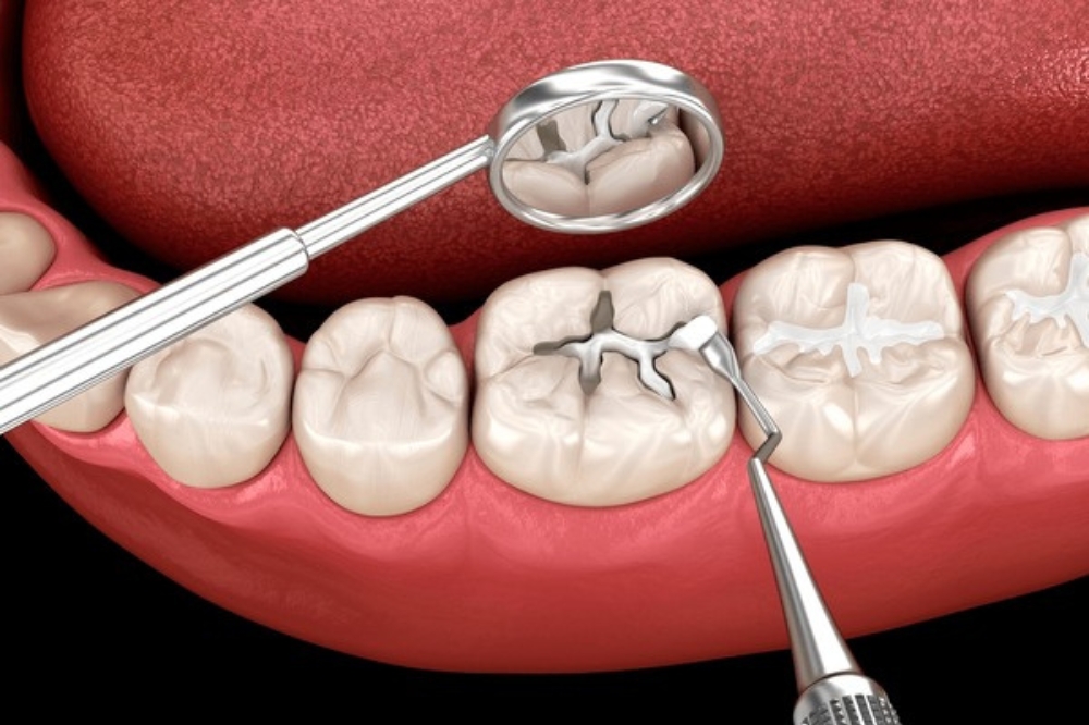 Can Dental Fillings Prevent Future Tooth Damage?