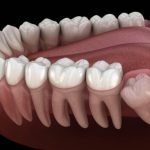 Wisdom Teeth Removal Recovery Timeline: Day-by-Day Guide