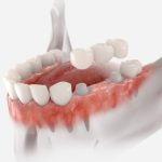 Are Dental Bridges Permanent or Temporary? What to Know