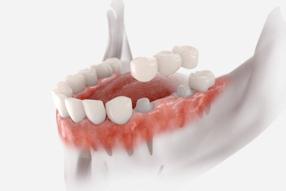Are Dental Bridges Permanent or Temporary? What to Know